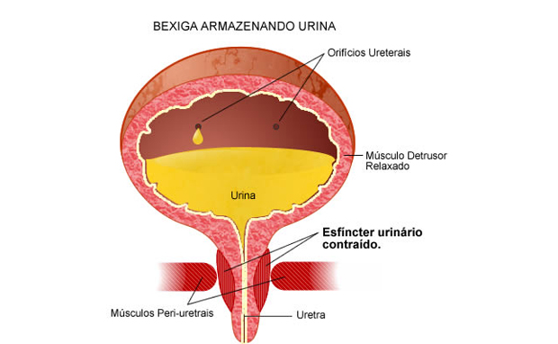 Incontinência Urinária