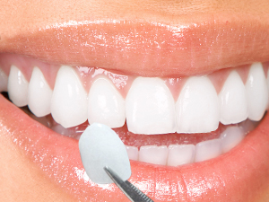 Lente de Contato Dental